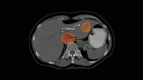 Killing More Cancer Cells than Ever Before: A New Era in Radiotherapy