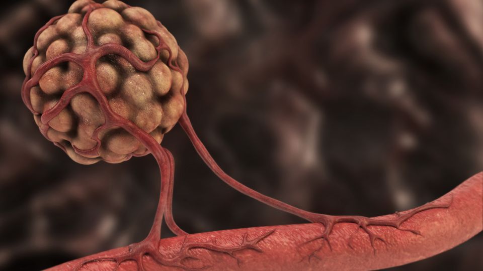 Use of AI advances adaptive radiotherapy for cancer care